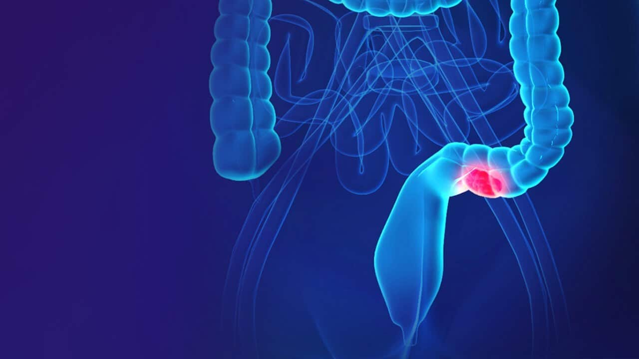 Bowel cancer