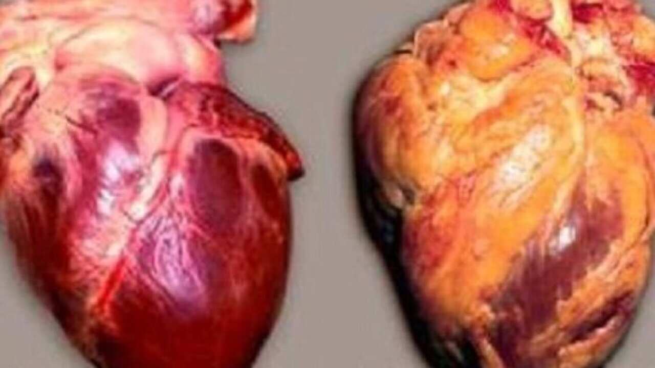 A healthy heart beside a damaged heart (SBS)