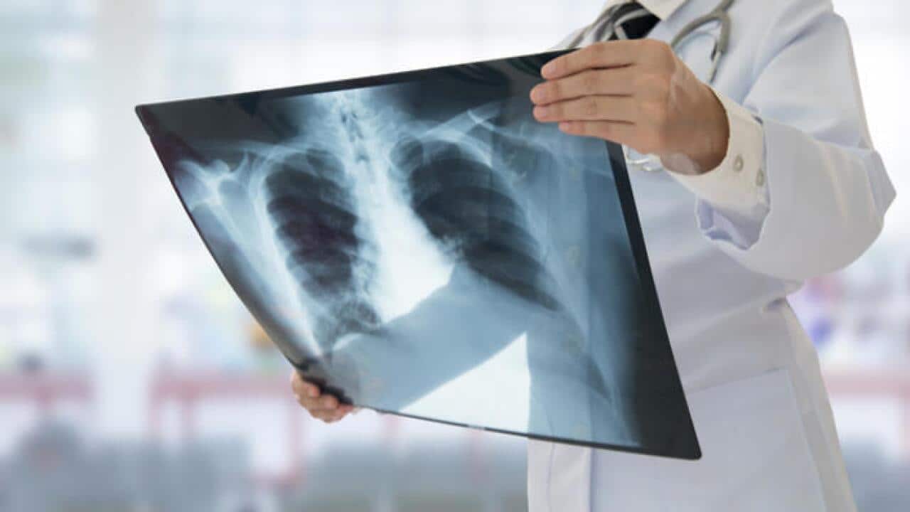 Chest X ray