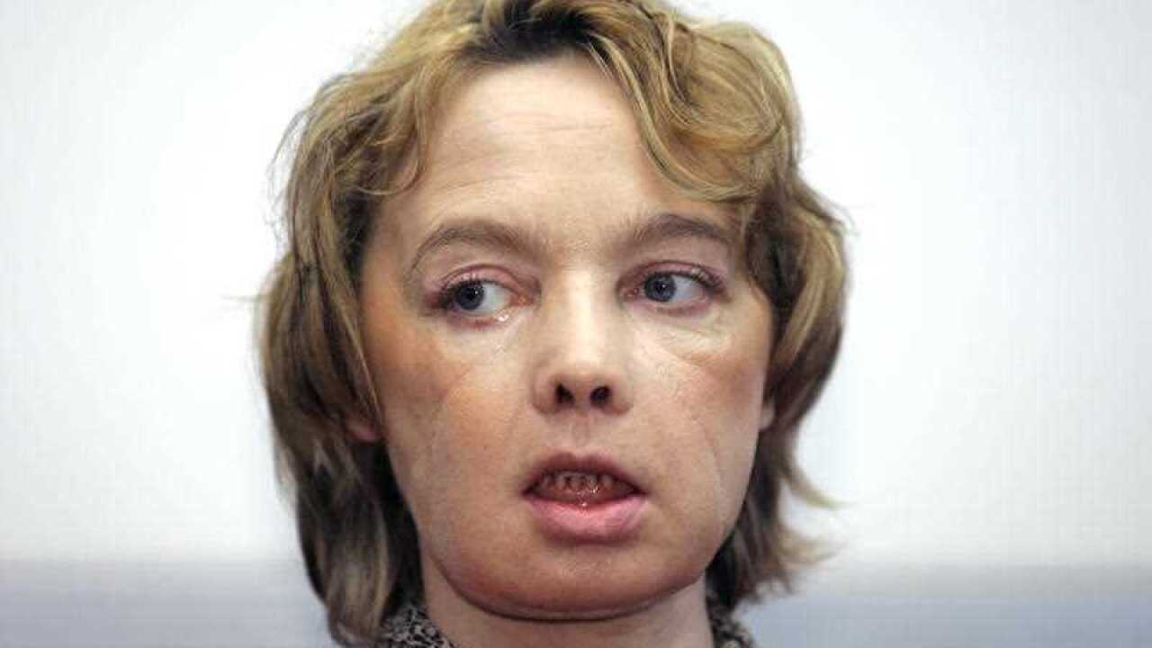 Isabelle Dinoire, the woman who received the world's first partial face transplant with a new nose, chin and mouth, in an operation on Nov. 27, 2005