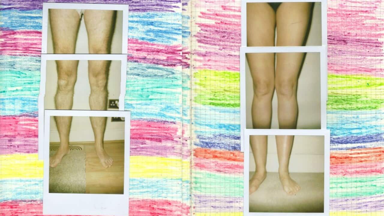 flickr boys nude Comment: Should we 'fix' intersex children? | SBS News