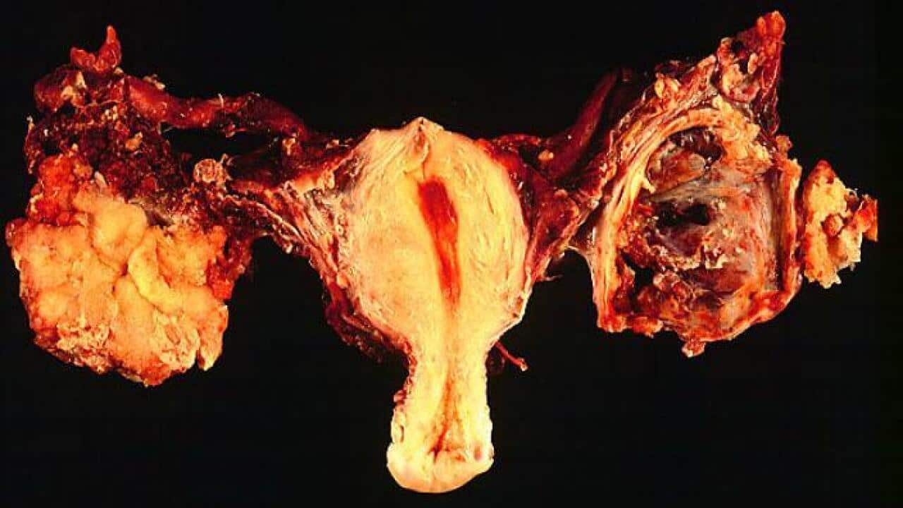 Ovarian cancer - Bilateral ovarian serous carcinomas, gross pathology (Ed Uthman- Public domain)