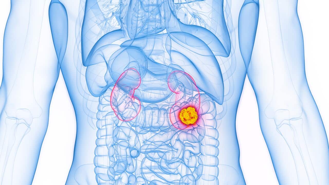 Kidney cancer, illustration