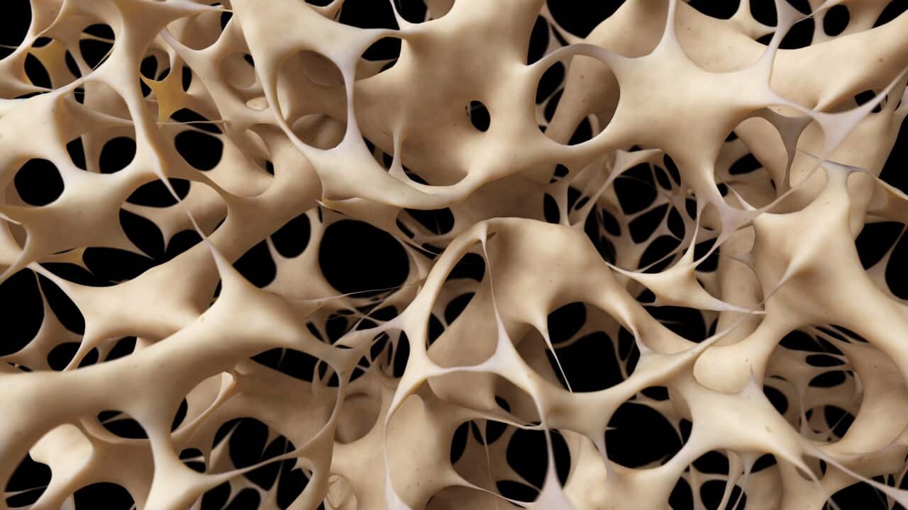 An illustration of human bones showing osteoporosis