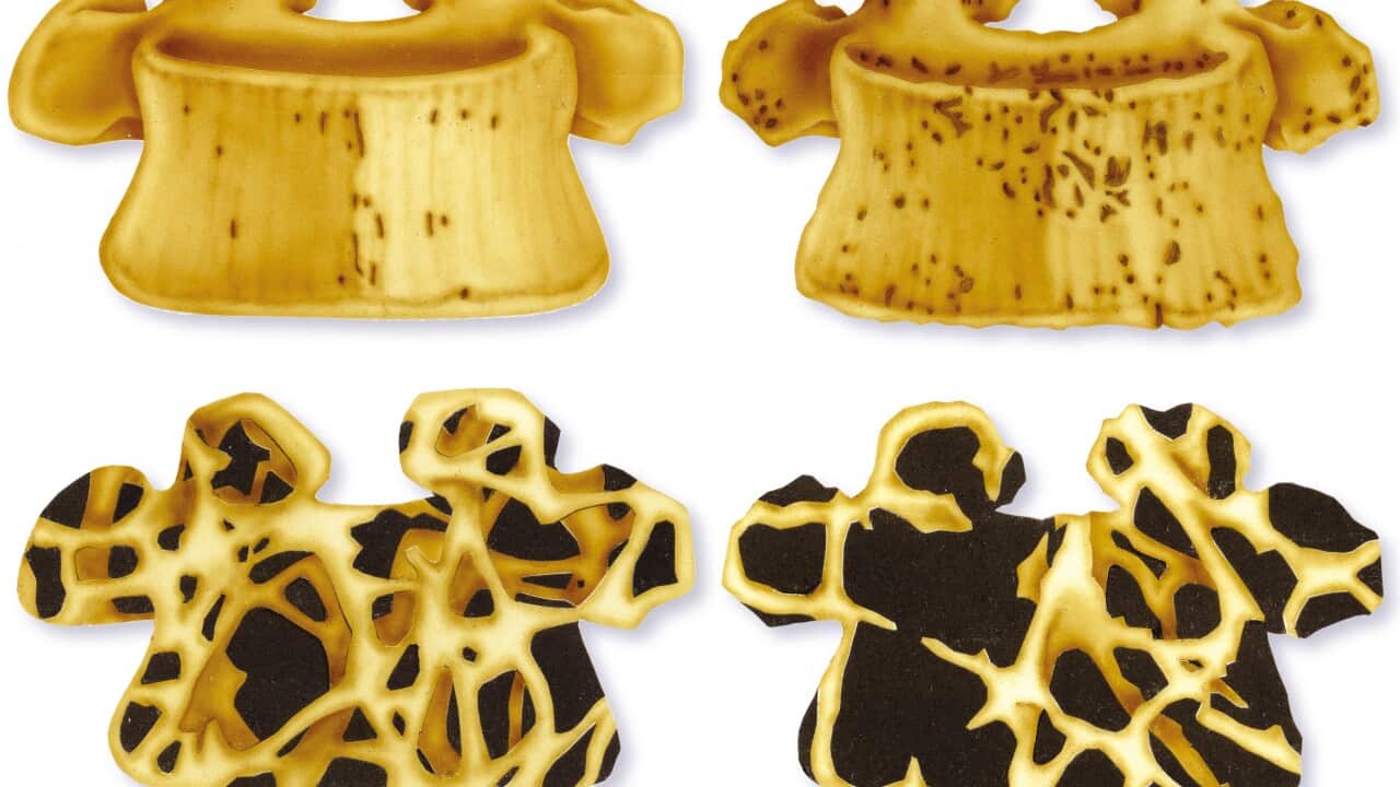 Osteoporosis, Illustration