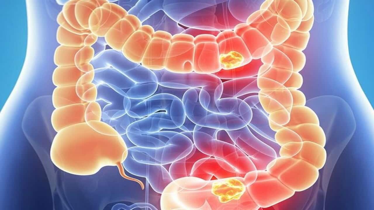 bowel cancer