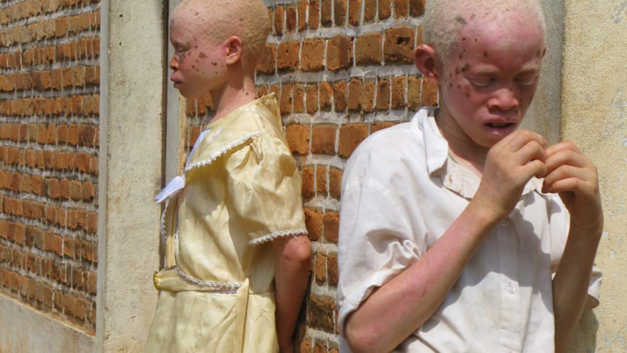 Albino children in Burundi