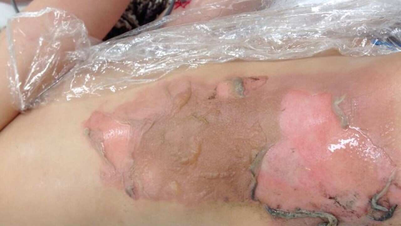 Burns suffered by Kieran, aged 5