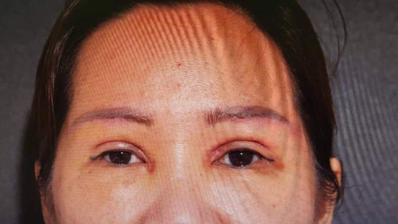 Đôi mắt sau khi được phẫu thuật