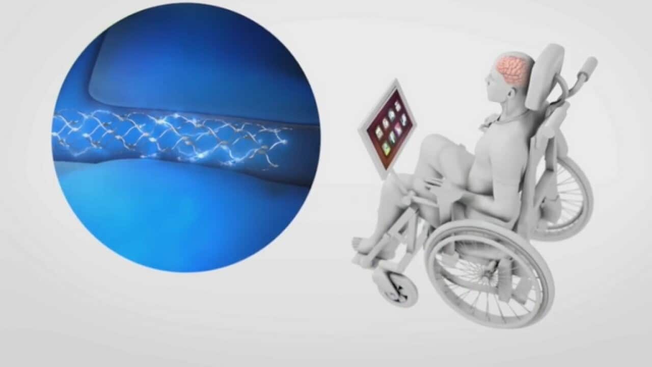 An artist’s impression of The Stentrode (SBS)