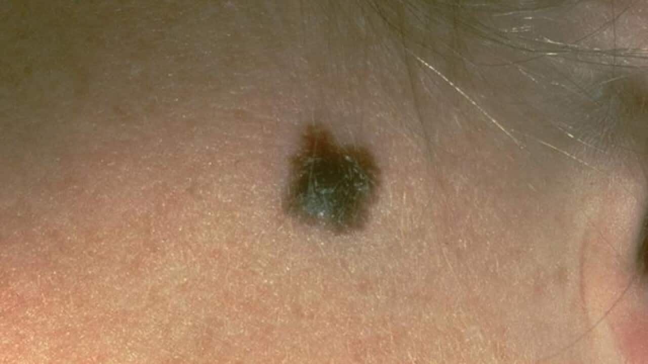 A mole that was diagnosed as melanoma (file image)