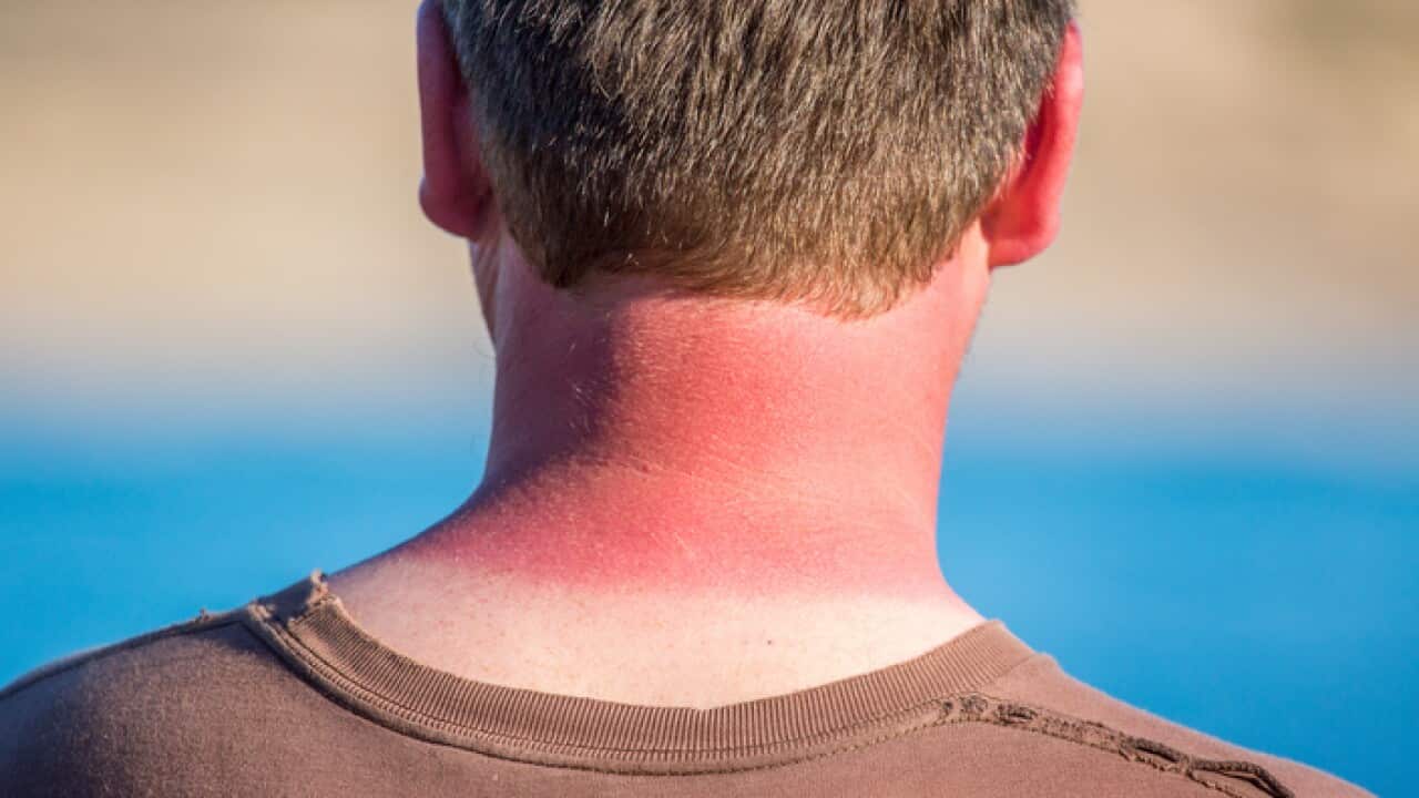 Sunburnt neck from too much sun. Australia