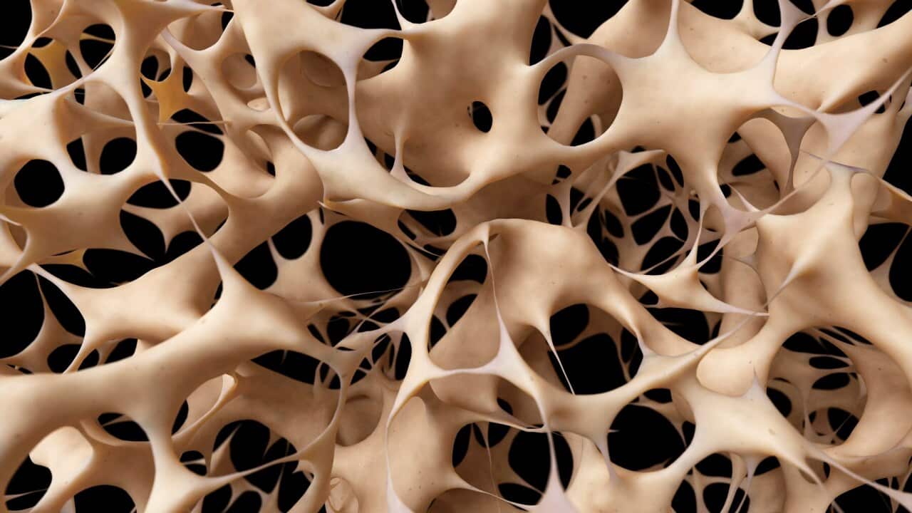 An illustration of human bones showing osteoporosis