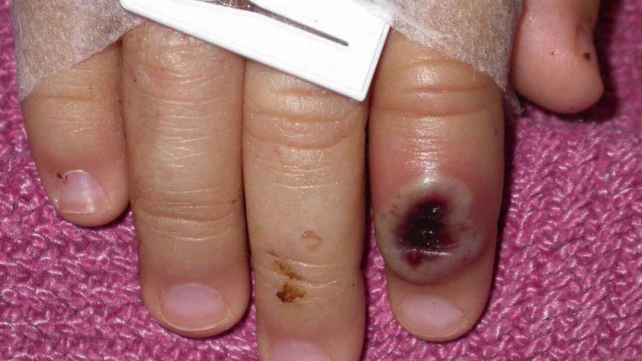 A skin lesion caused by the monkeypox virus (AAP).