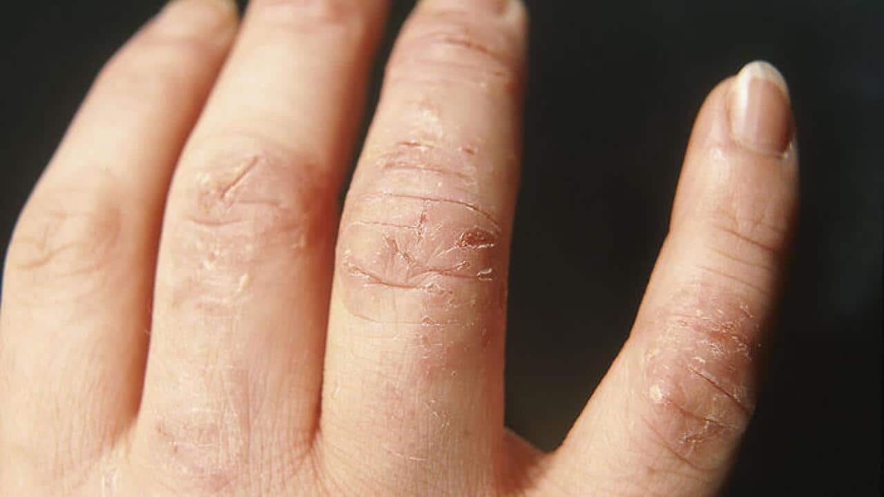 Dry Skin