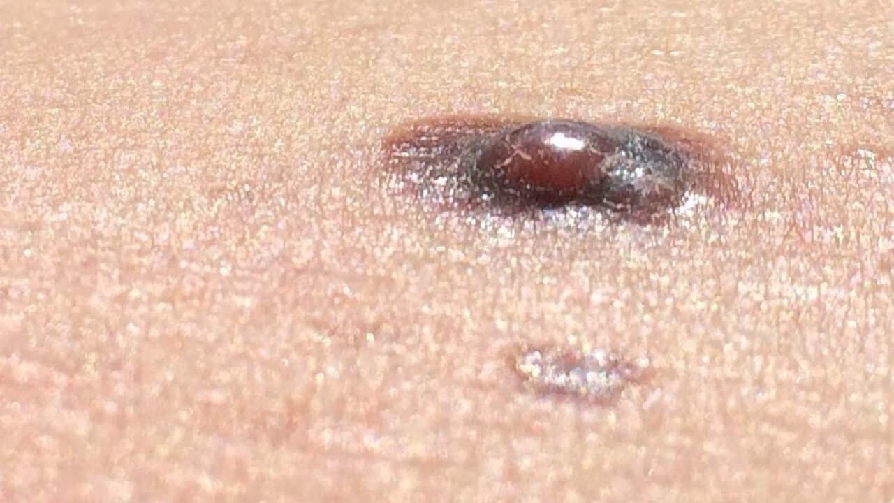 nodular melanoma