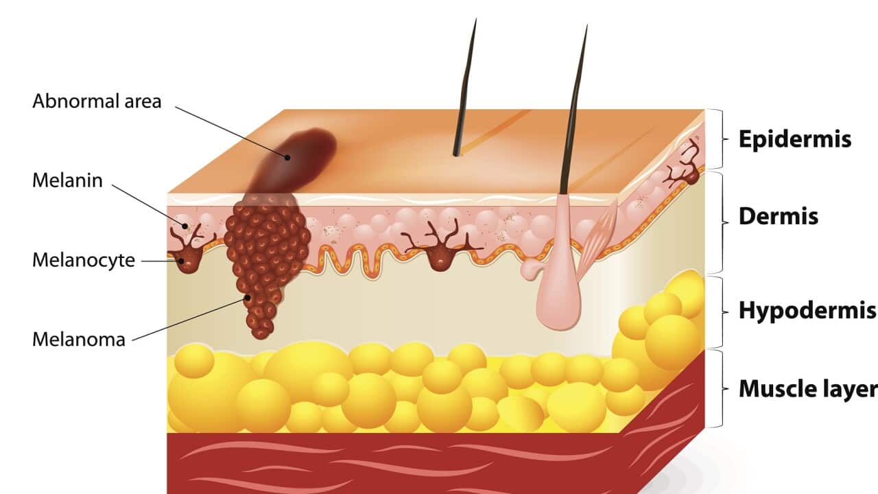 Melanoma or skin cancer