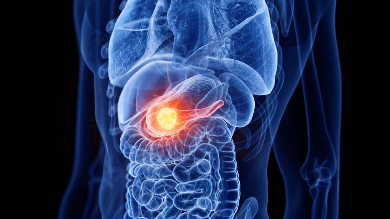 Pancreas cancer, illustration