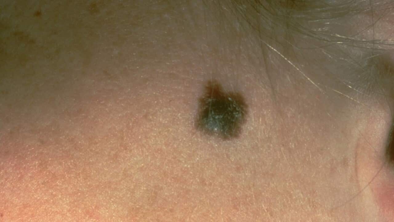 A suspicious mole that was diagnosed as a melanoma (AAP)