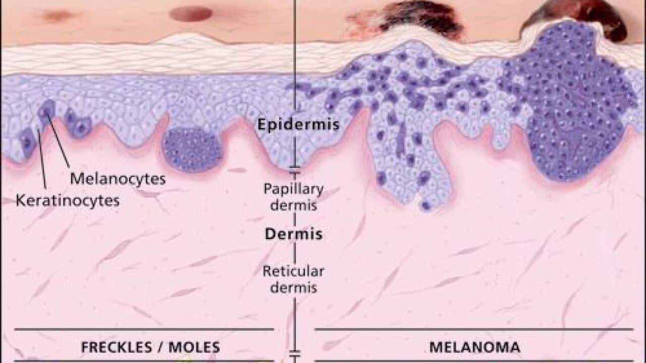 Melanoma