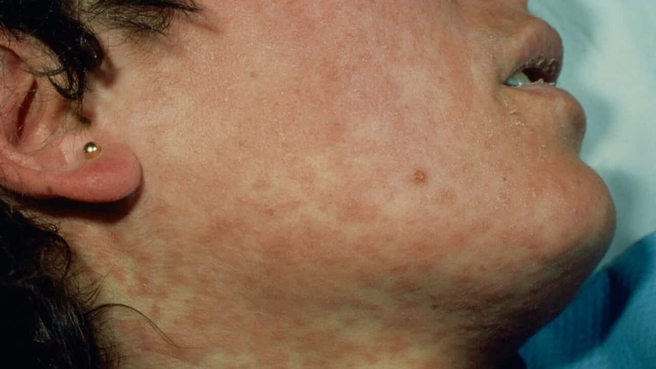 File image of a measles sufferer.