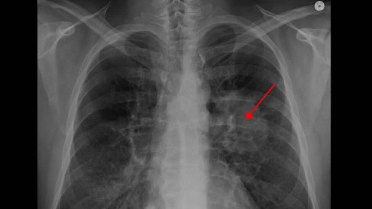 World Lung cancer awareness month 
