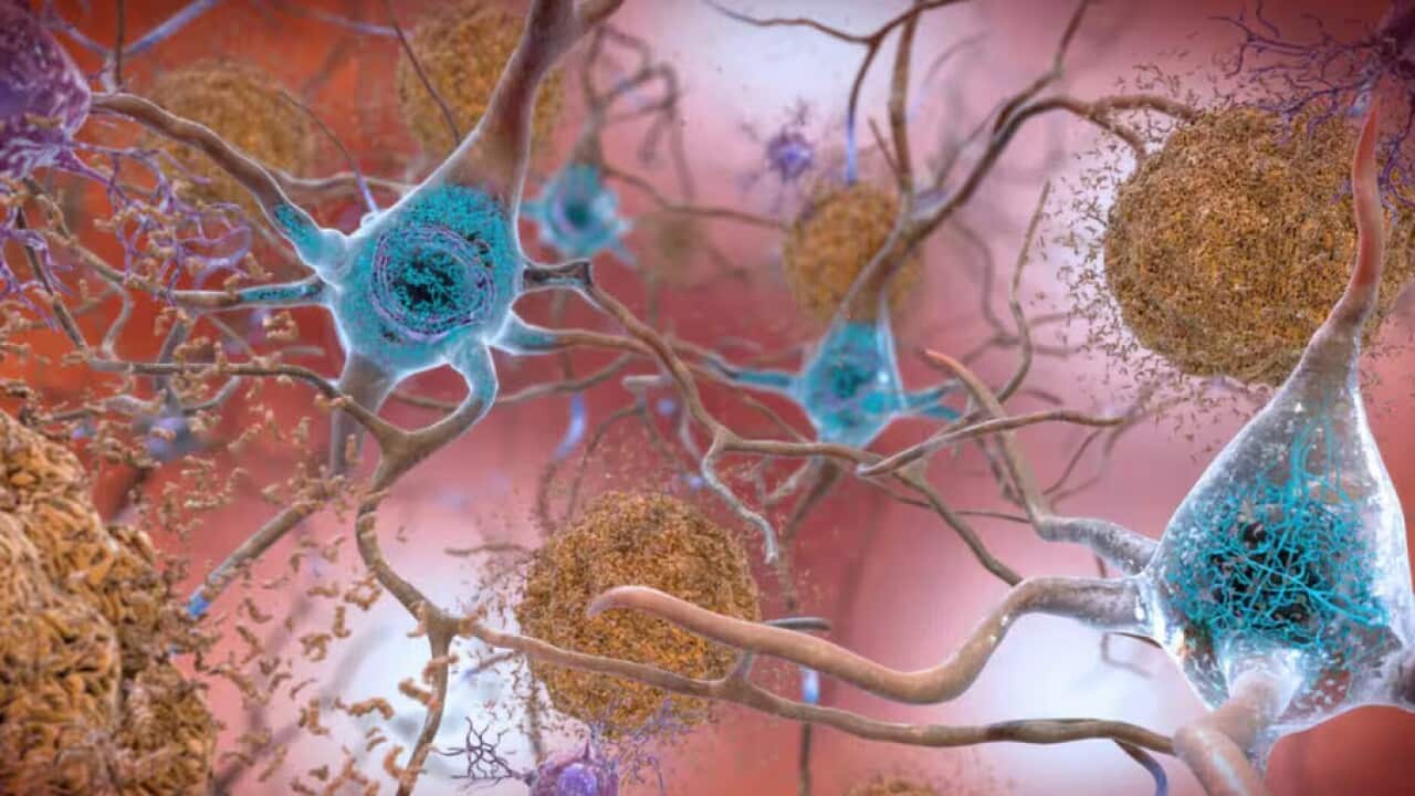 Alzheimer.jpg