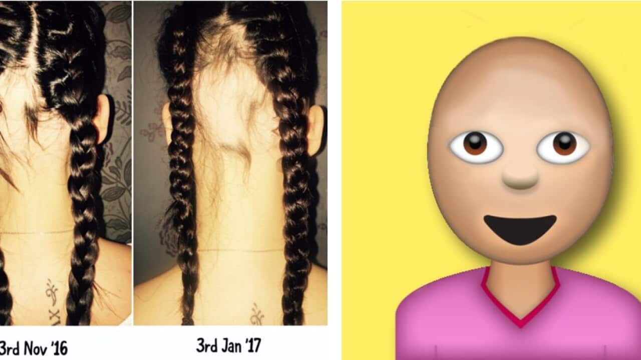 The woman behind the bald emoji petition suffers from alopecia areata.