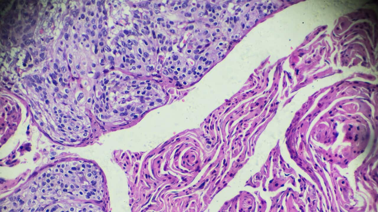 Cervical Cancer (Squamous cell carcinoma) under light microscopy
