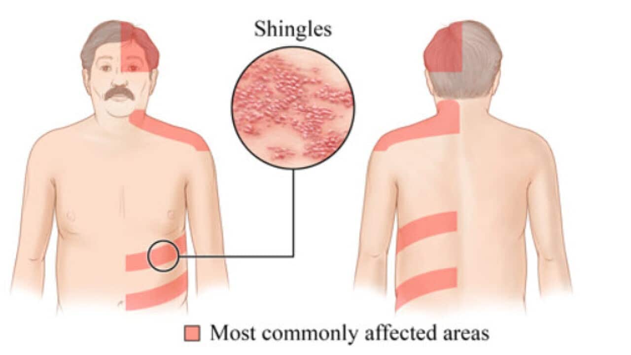 The shingles rash usually develops on one side of the body