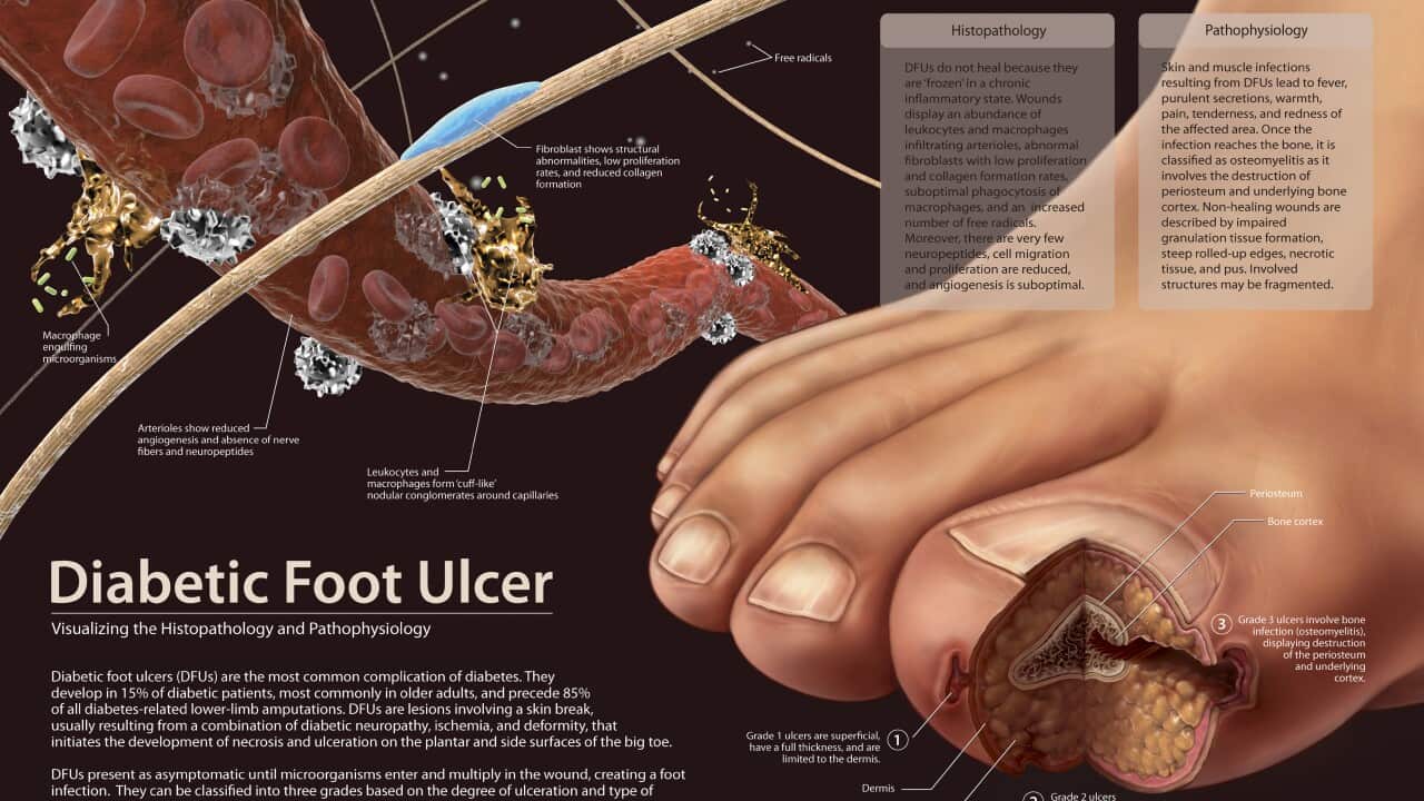 Histopathology and pathophysiology of diabetic food ulcers.