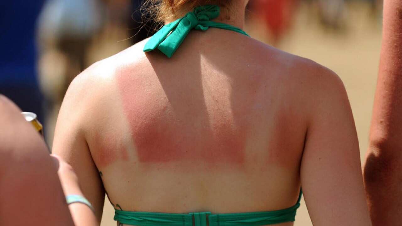 A woman with a sunburnt back