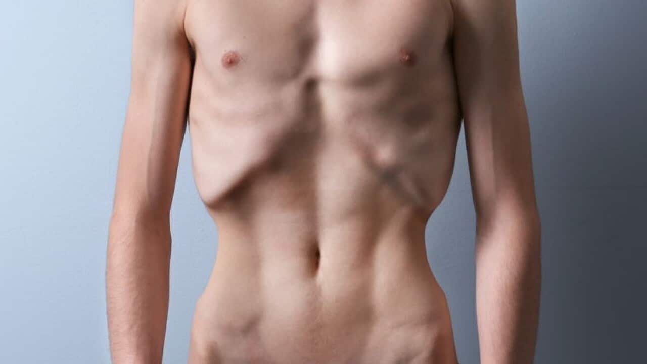 Eating disorder