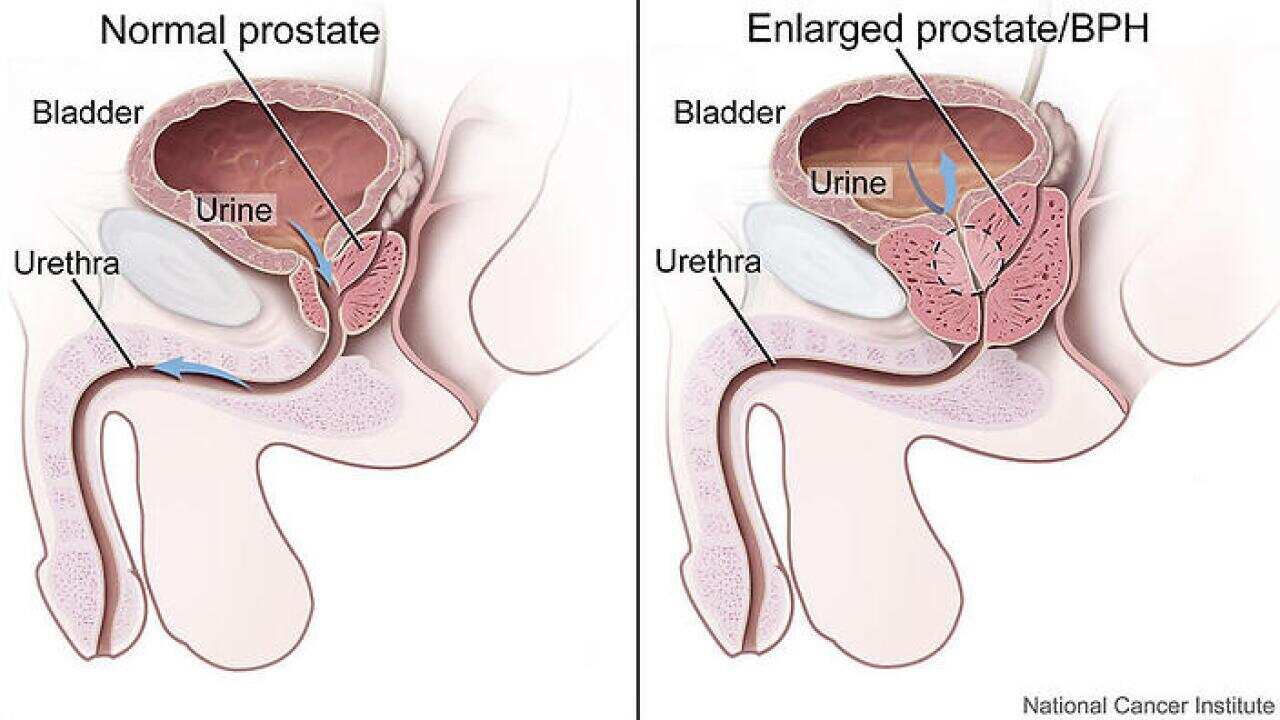 Prostate cancer
