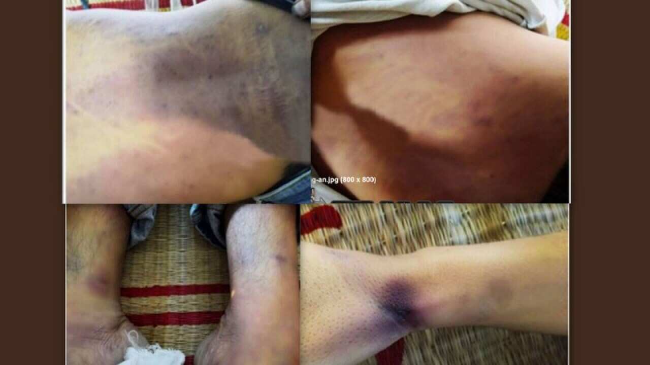 Vết bầm trên người anh Nguyễn Ngọc Nhân 29 tuổi ở Tân Phú Tân Đông Tiền Giang chêt khi bị bắt về đồn công an mà công an cho là chết do nhồi máu cơ tim.