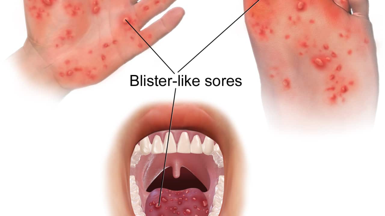 Hand_Foot_&_Mouth_Disease - Wikimedia Commons.png