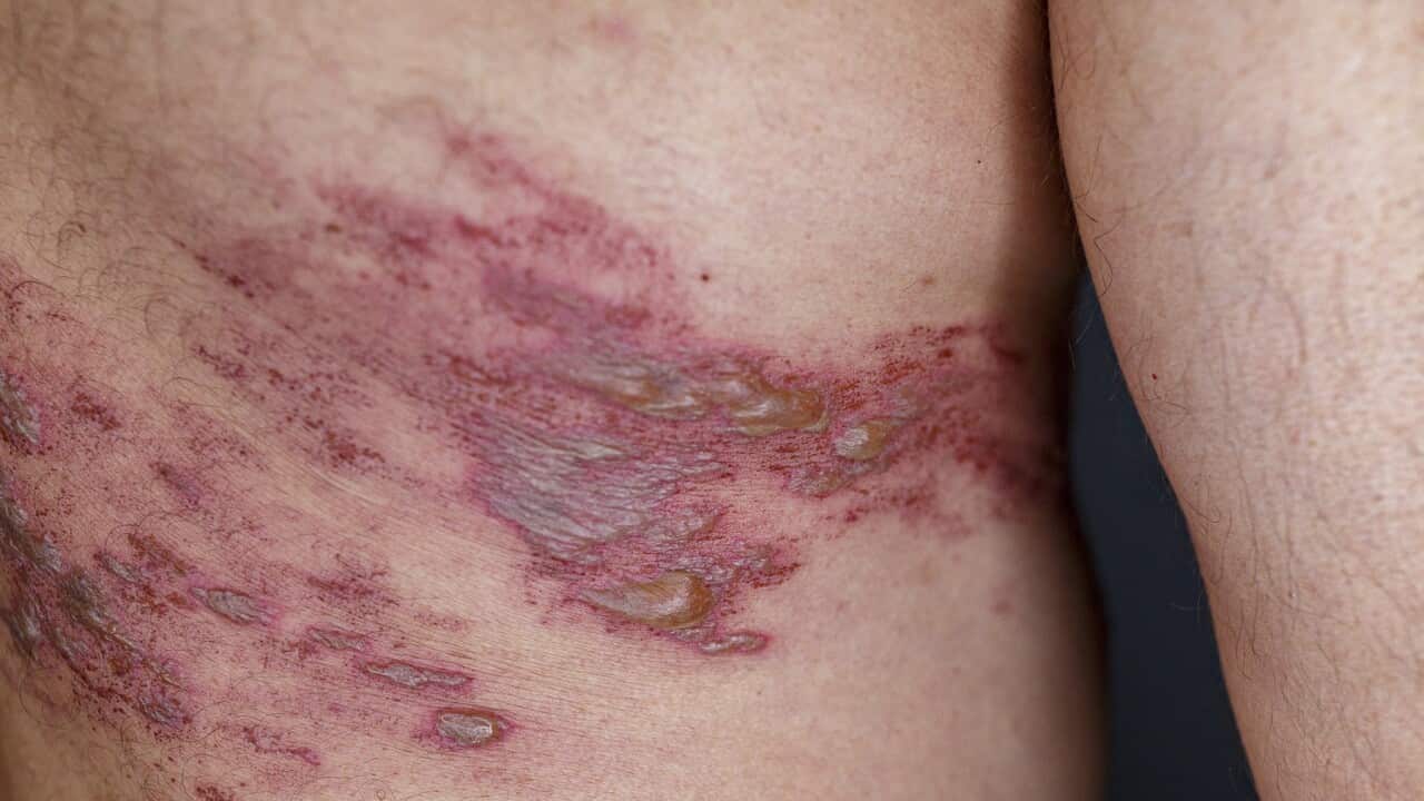 Skin lesion symptom caused by shingles (Herpes zoster) (Getty).