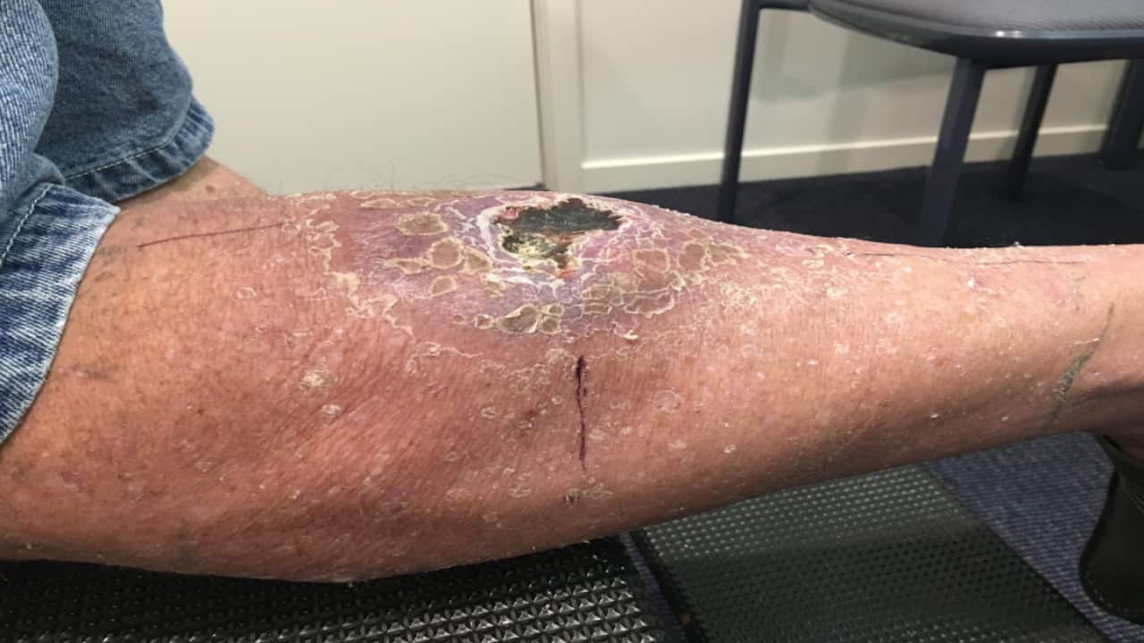 A Buruli ulcer.
