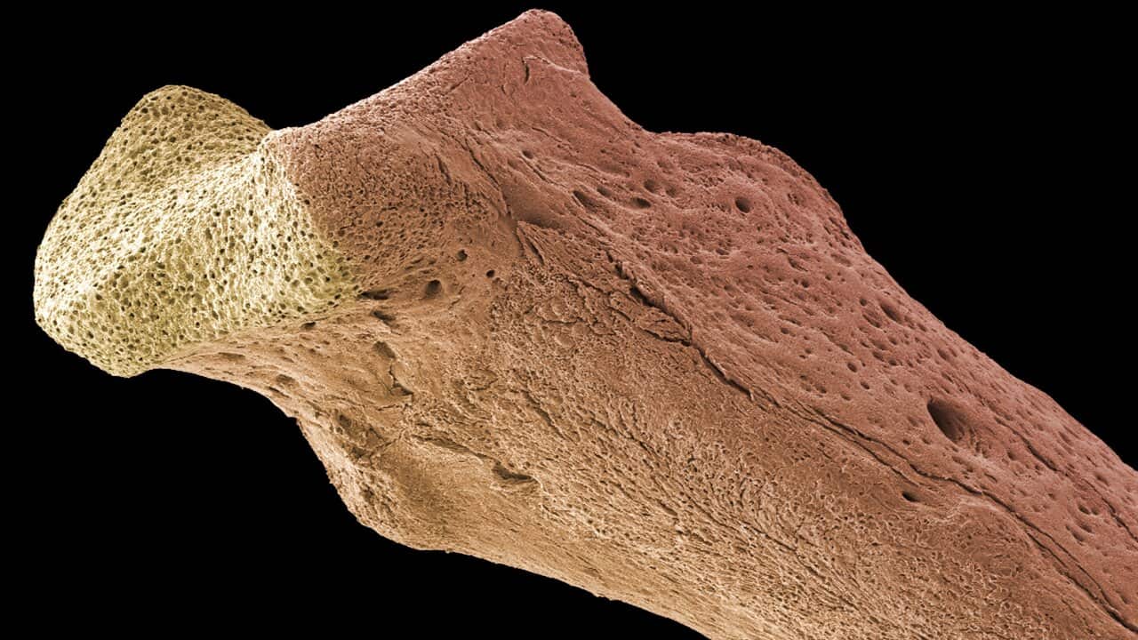 Scanning electron micrograph (SEM) of human bone, osteoporosis