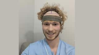 Two images of Tom Robb in different stages of his hair transplant that show the progress of his hair tracking