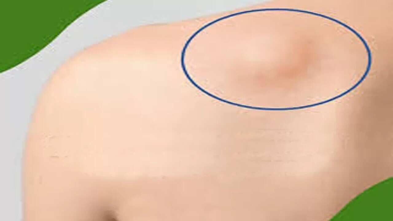 Sarcoma Cancer