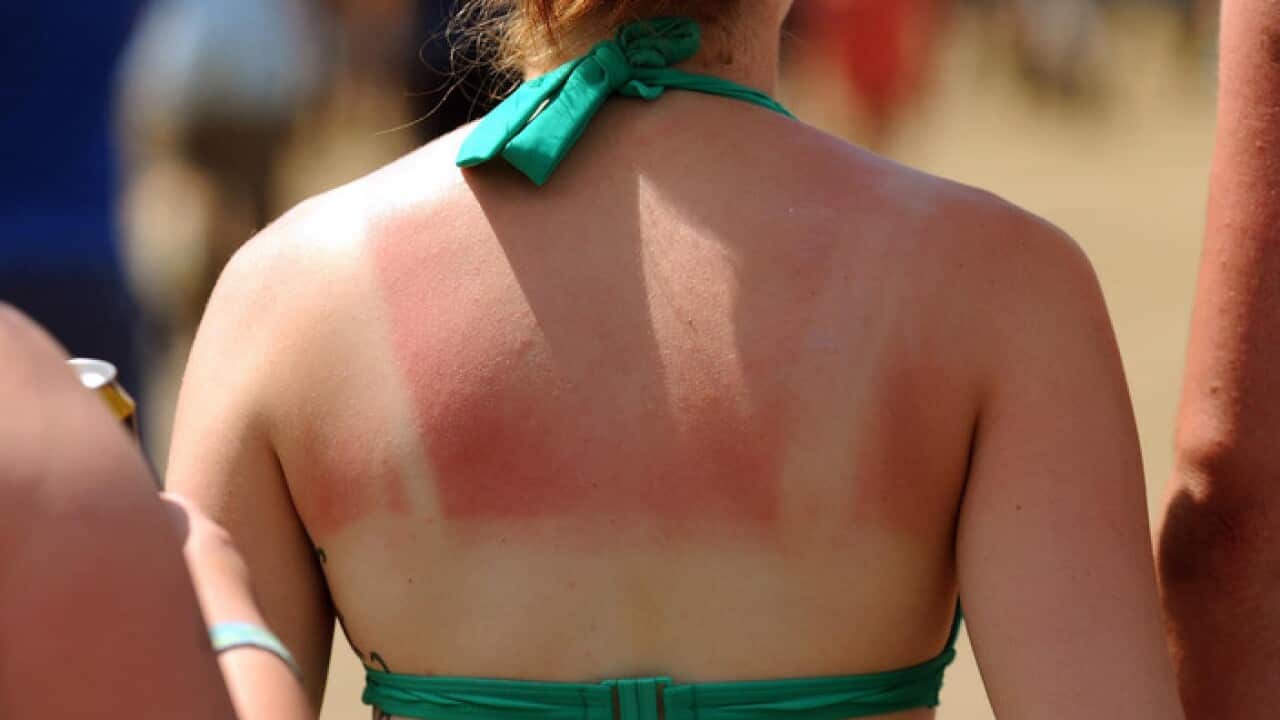 Woman with sunburnt back