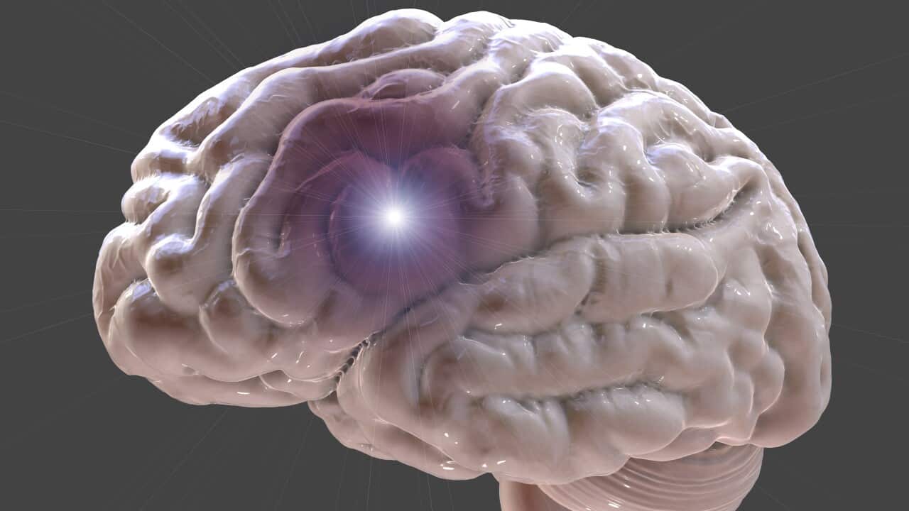 Stroke, illustration