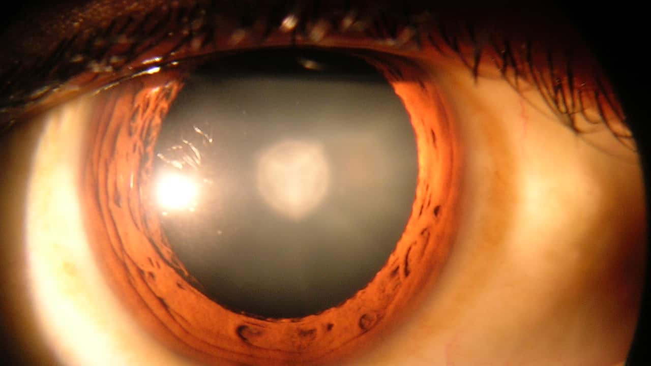 Eye with cataract