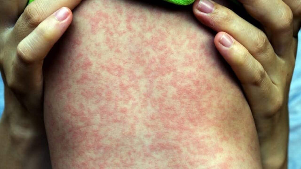 Health authorities are reporting a global resurgence in measles cases