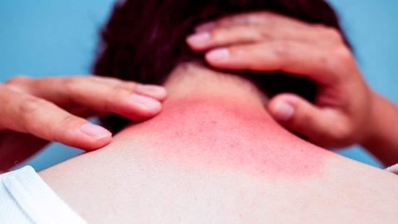 skin burns in the summer
