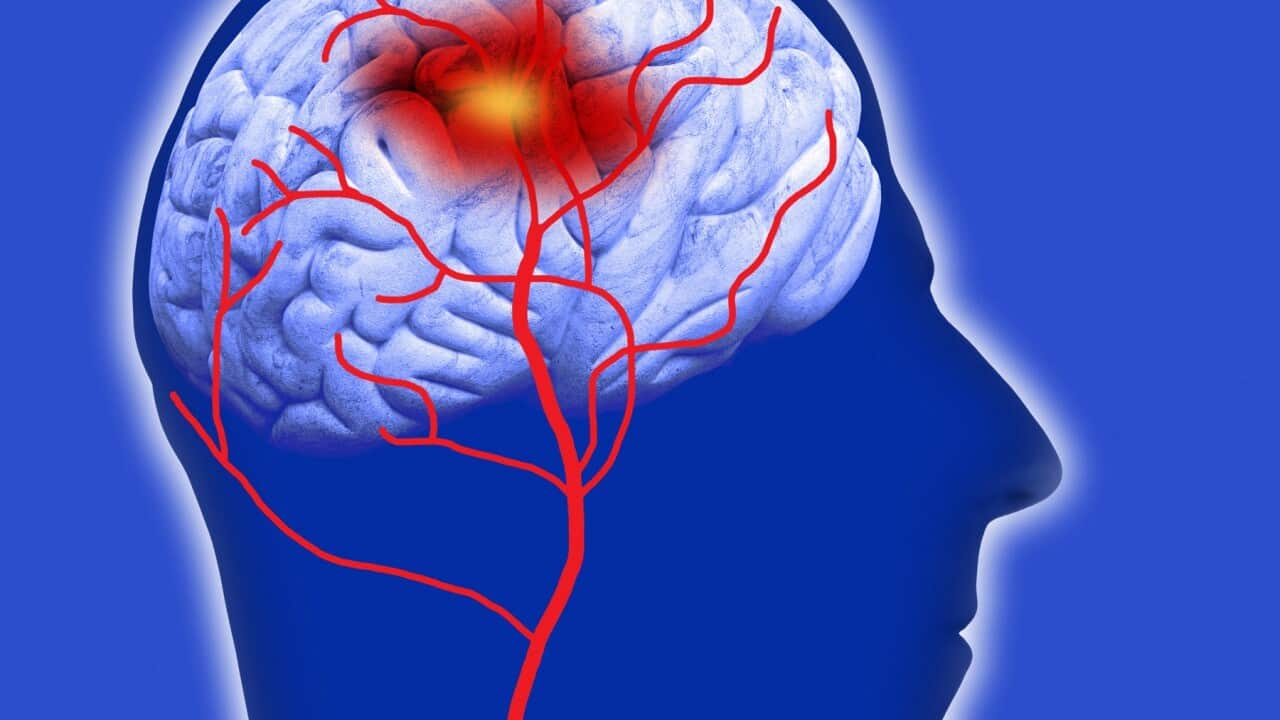 Human brain showing stroke
