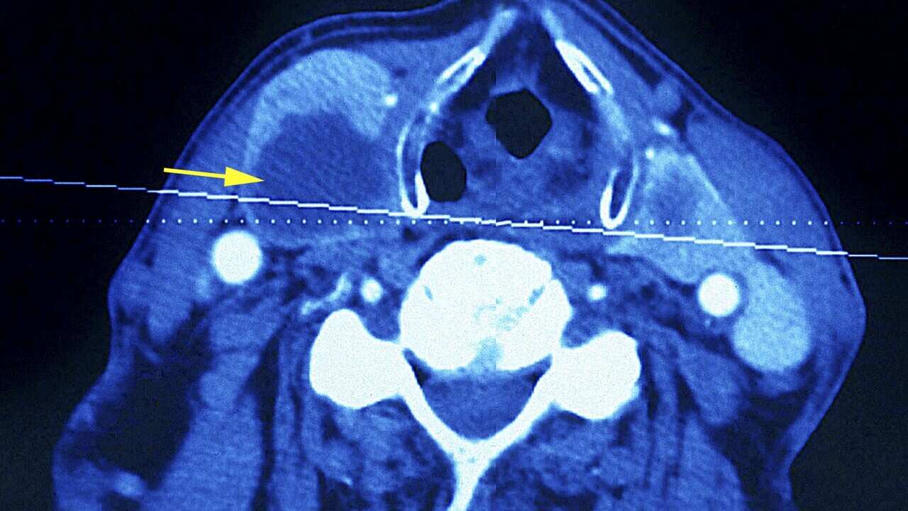 Thyroid Nodule, Scan
