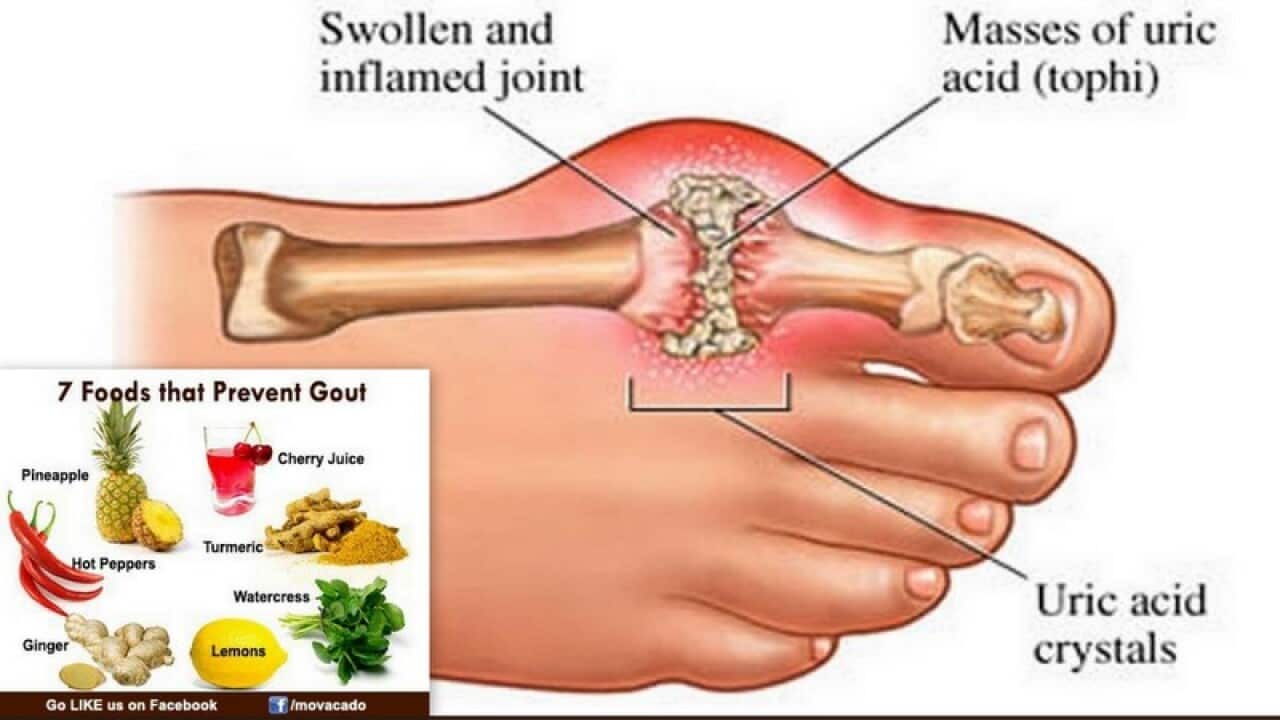 Khớp ngón chân cái của người bị bệnh gout