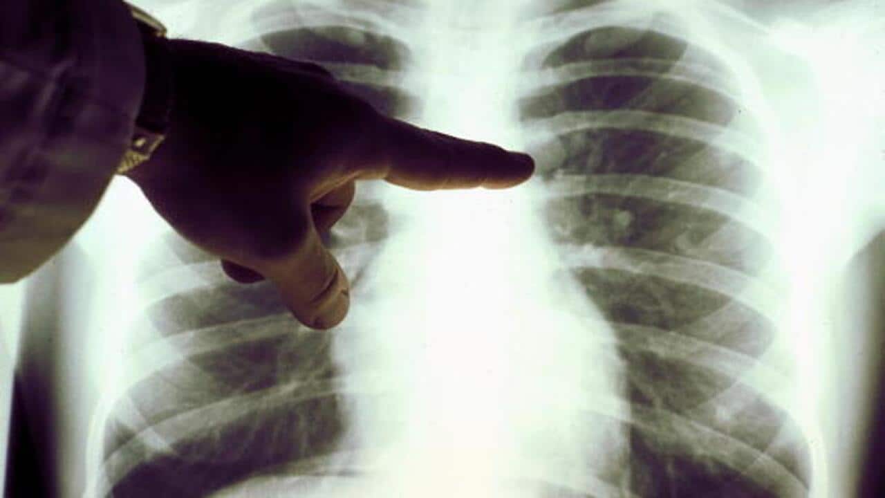 Lung overtakes breast as biggest cancer killer of Victoria’s women